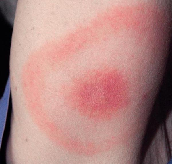 A bulls-eye rash that was diagnosed to be Lyme disease